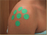 Mesotherapy in the shoulder.