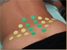 Mesotherapy in the lumbar region.