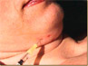 Double chin mesotherapy.