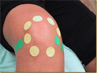 Mesotherapy in the knee.