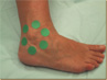 Mesotherapy in the ankle.
