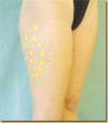Mesoterapia en caderas, distribución de ppulas en zona celulítica.