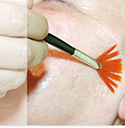 Peelings químicos.